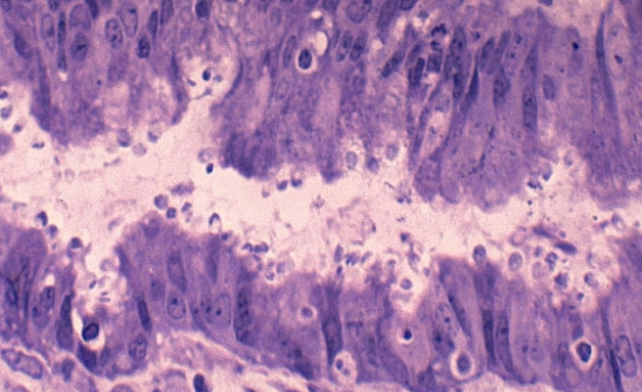 一期梅毒的临床表现主要是什么