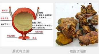 膀胱炎对男性的身体有哪些威胁？