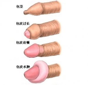 去资阳割包皮需多少钱呢？