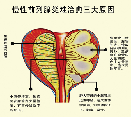 患上前列腺炎会不会影响男性的性功能?