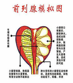 前列腺炎该怎么治疗