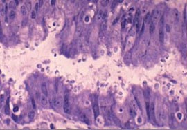 生殖器疱疹是如何传染的?