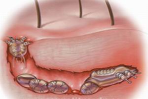 非淋菌性尿道炎应该做什么检查?