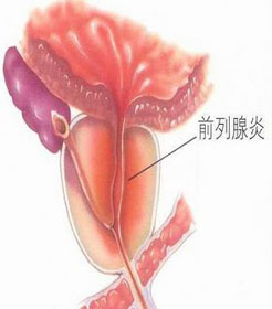 非细菌性前列腺炎会产生什么危害