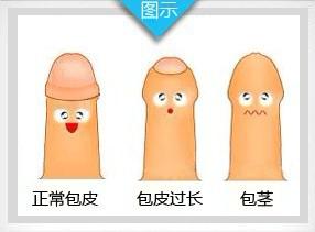 做包茎手术后的注意事项