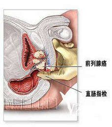 前列腺炎会传染吗