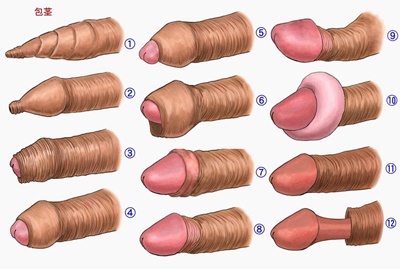 怎样判断男性包皮过长
