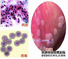 尖锐湿疣的早期症状有哪些