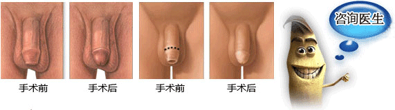 哪些是包皮过长埋下的隐患？