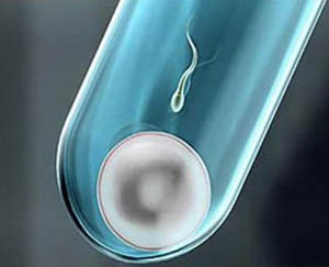 弱精症造成男性不孕不育