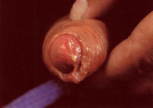 得了淋病该做哪些检查呢