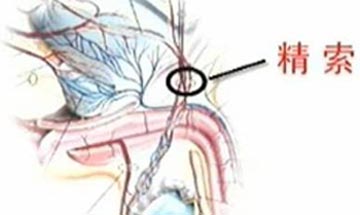 精索静脉曲张与生育有什么关系